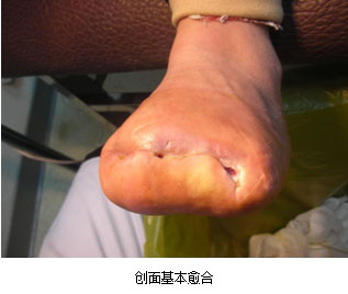 9170金沙集团_哈尔滨医科大学第一临床医院应用再生医疗手艺治愈一例糖尿病足坏疽