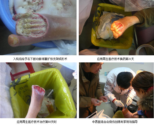 9170金沙集团_哈尔滨医科大学第一临床医院应用再生医疗手艺治愈一例糖尿病足坏疽
