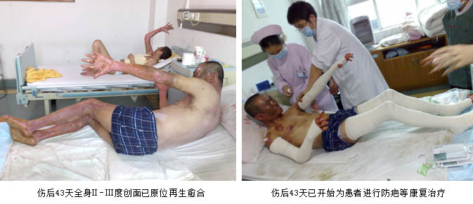 9170金沙集团_皮肤原位再外行艺乐成救治大面积严重烧伤台胞一家四口