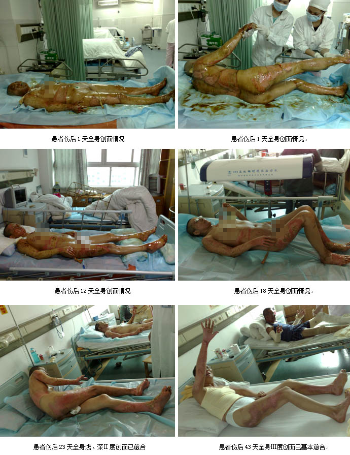 9170金沙集团_皮肤原位再外行艺乐成救治大面积严重烧伤台胞一家四口