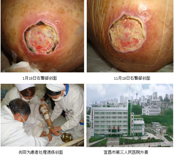 9170金沙集团_再生回复医疗手艺在宜昌市第三人民医院应用纪实（二）