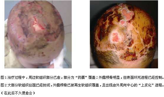 9170金沙集团_湿润烧伤膏纱条治疗体表脓肿的疗效视察