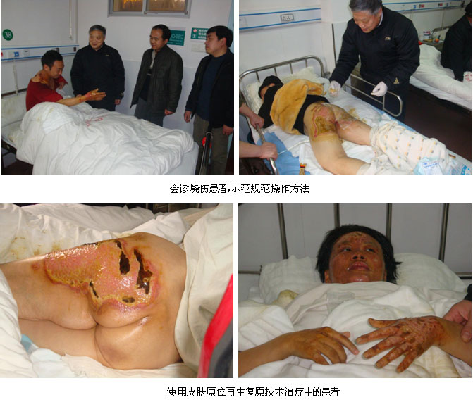 9170金沙集团_皮肤原位再生回复手艺在下层医院临床创面处置惩罚规范应用