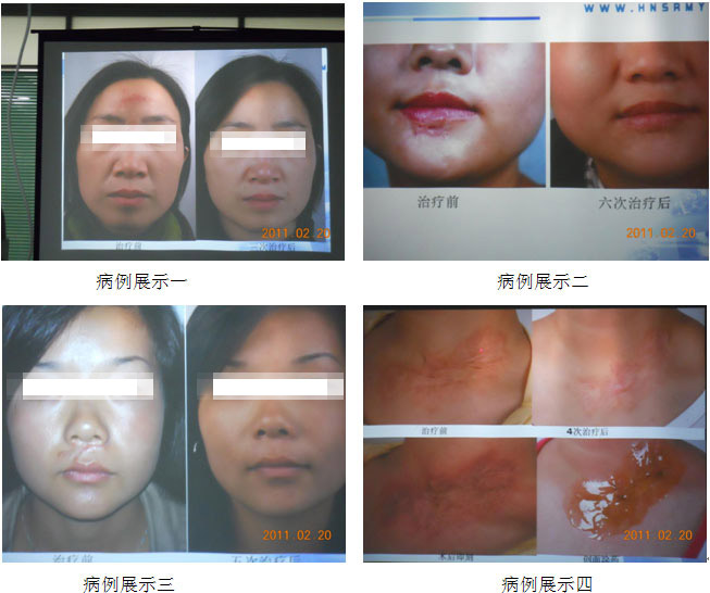 9170金沙集团_湖南省人民医院烧伤整形美容科举行皮肤原位再生回复手艺修复疤痕的高级钻研会