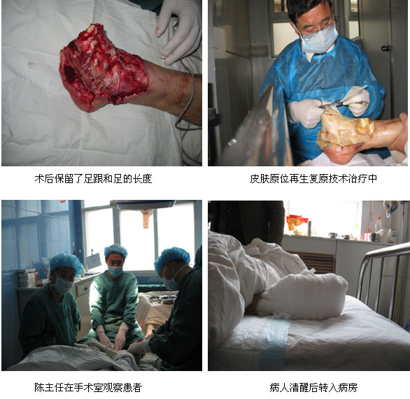 9170金沙集团_皮肤原位再生回复手艺在河南许昌市抢救糖尿病足伴熏染性休克病人获得乐成