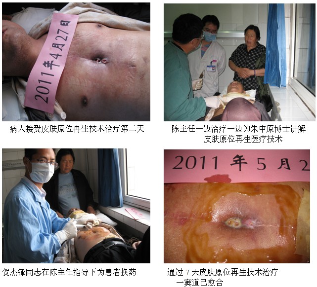 9170金沙集团_皮肤原位再生医疗手艺在汴京市第一人民医院普照生辉
