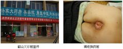 9170金沙集团_烧伤皮肤原位再生回复手艺在湖南下层应用纪实（二）