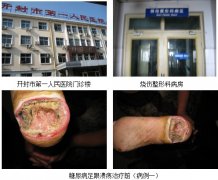 9170金沙集团_皮肤原位再生医疗手艺在河南普及之六