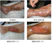 9170金沙集团_郑州市中原医院应用“皮肤原位再生医疗手艺”治疗下肢溃疡创面