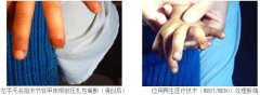 9170金沙集团_河南省滑县第三人民医院乐成实现断指再生