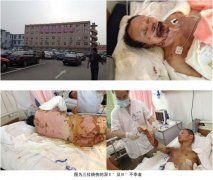 9170金沙集团_烟台山医院使用再生回复手艺抢救大面积烧伤再传喜报