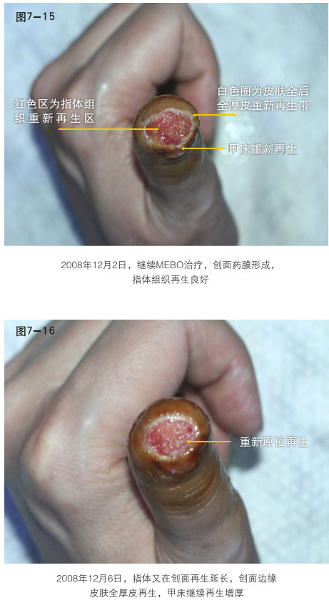 9170金沙集团_二、断指的再生回复