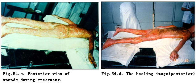9170金沙集团_Clinical Demonstrations of Burns Regenerative Medicine and T