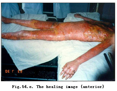9170金沙集团_Clinical Demonstrations of Burns Regenerative Medicine and T