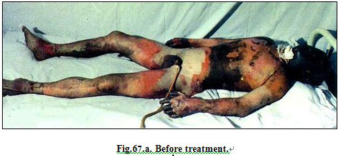 9170金沙集团_Clinical results of Surgical Excision and Skin Grafting Ther