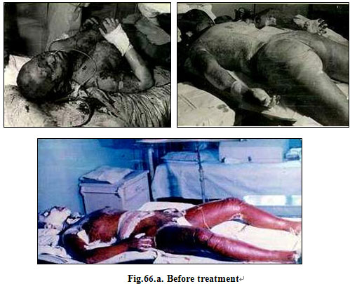 9170金沙集团_Clinical results of Surgical Excision and Skin Grafting Ther
