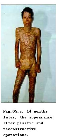 9170金沙集团_Clinical results of Surgical Excision and Skin Grafting Ther