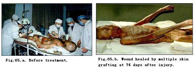 9170金沙集团_Clinical results of Surgical Excision and Skin Grafting Ther