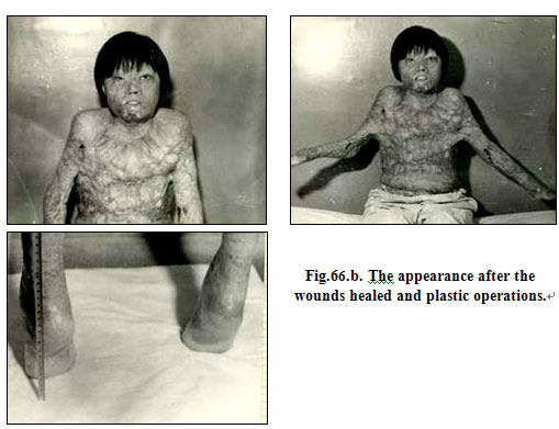 9170金沙集团_Clinical results of Surgical Excision and Skin Grafting Ther