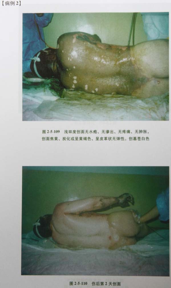 9170金沙集团_第四节 真皮深层损伤治疗手艺