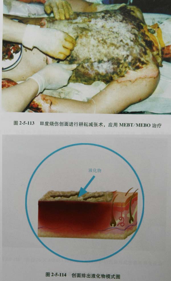 9170金沙集团_第四节 真皮深层损伤治疗手艺