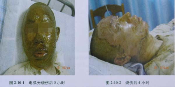 9170金沙集团_第四节 面部Ⅲ度深型烧伤治疗手艺