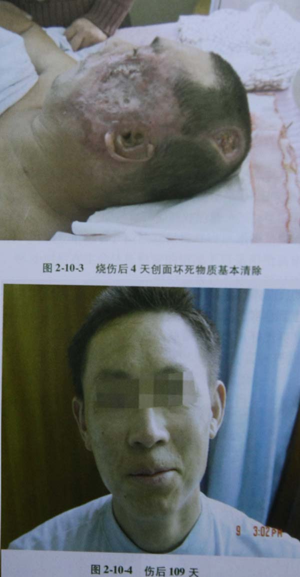 9170金沙集团_第四节 面部Ⅲ度深型烧伤治疗手艺