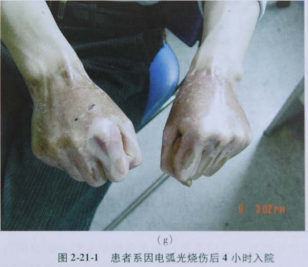 9170金沙集团_第四节 应激性溃疡防治手艺