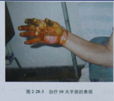 9170金沙集团_第二节 电弧烧伤病人照顾护士