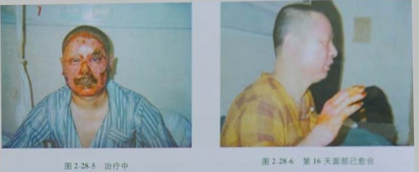 9170金沙集团_第二节 电弧烧伤病人照顾护士