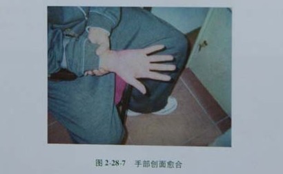 9170金沙集团_第二节 电弧烧伤病人照顾护士