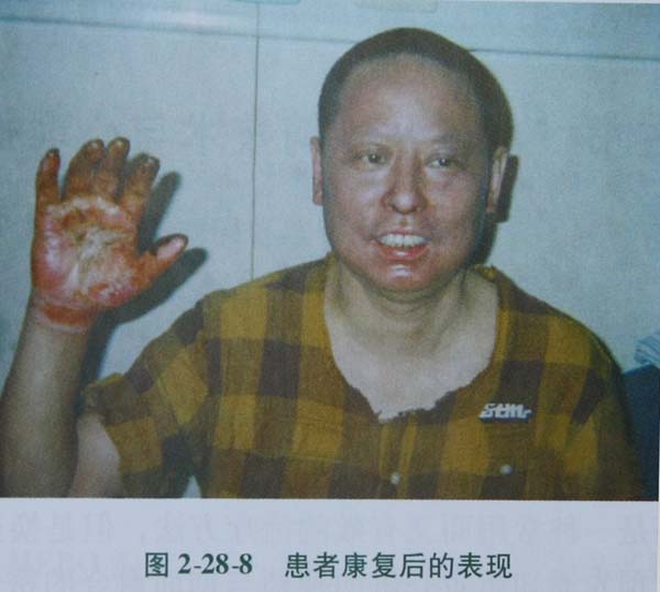 9170金沙集团_第二节 电弧烧伤病人照顾护士