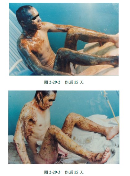 9170金沙集团_第三节 硫酸烧伤治疗手艺