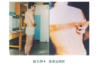 9170金沙集团_第三节 硫酸烧伤治疗手艺