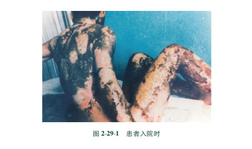 9170金沙集团_第三节 硫酸烧伤治疗手艺