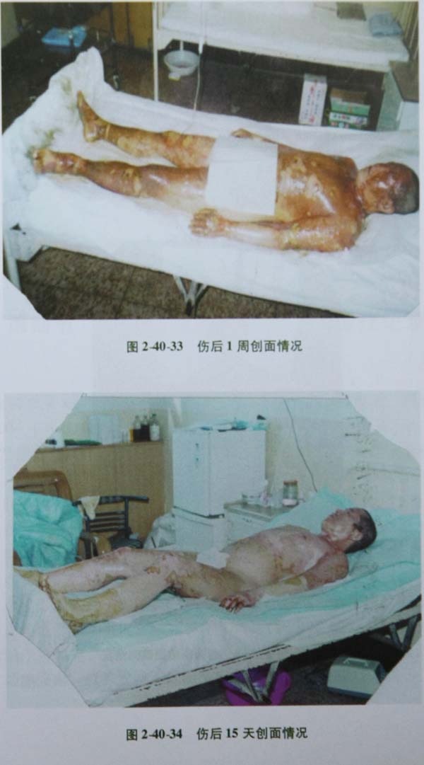 9170金沙集团_第三节 特大面积烧伤病例(3)治疗纪录