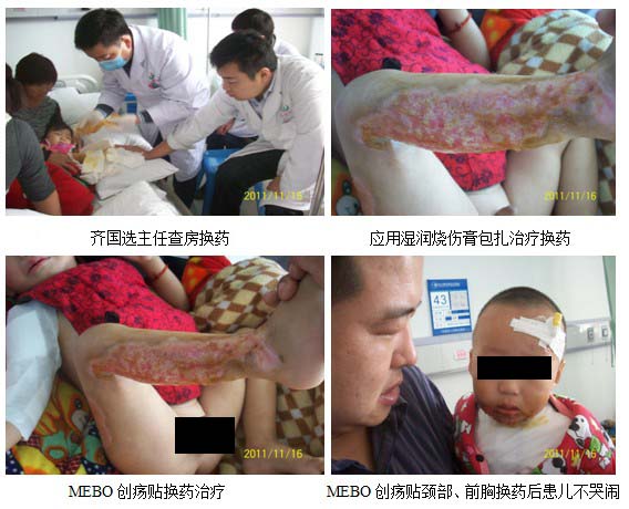 9170金沙集团_再生回复手艺走进皖北煤电总医院烧伤科回访