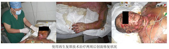 9170金沙集团_烟台山医院使用再生回复手艺治疗大面积烧伤病人剪影