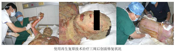 9170金沙集团_烟台山医院使用再生回复手艺治疗大面积烧伤病人剪影