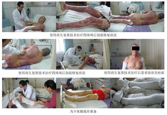 9170金沙集团_烟台山医院使用再生回复手艺治疗大面积烧伤病人剪影