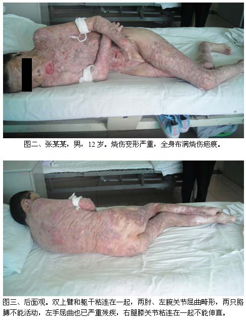9170金沙集团_再生医疗手艺接诊100%烧伤疤痕患儿一例系列报道之一