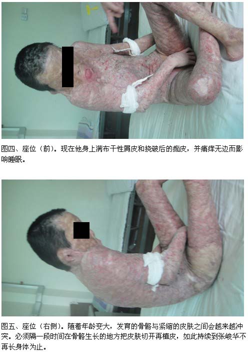 9170金沙集团_再生医疗手艺接诊100%烧伤疤痕患儿一例系列报道之一