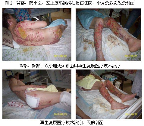 9170金沙集团_皖北煤电总医院再生回复医疗手艺临床实践系列报道（一）
