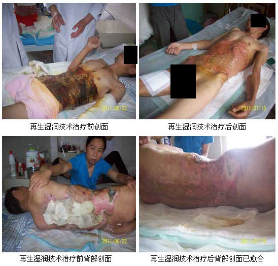 9170金沙集团_皖北煤电总医院再生回复手艺临床实践系列报道（二）