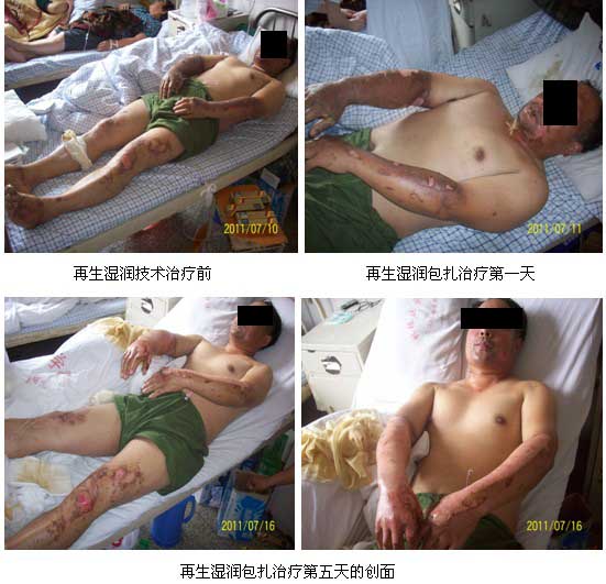 9170金沙集团_皖北煤电总医院再生回复手艺临床实践系列报道（二）