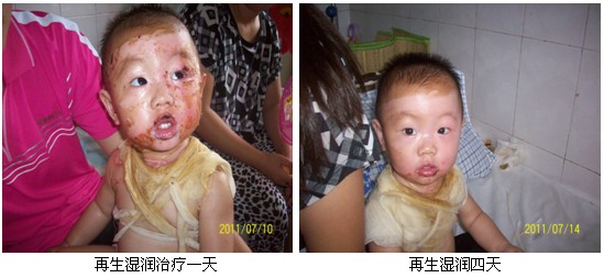 9170金沙集团_皖北煤电总医院再生回复手艺临床实践系列报道（二）