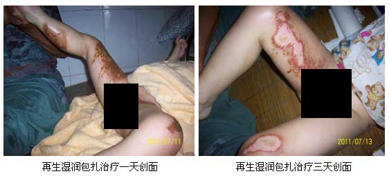 9170金沙集团_皖北煤电总医院再生回复手艺临床实践系列报道（二）