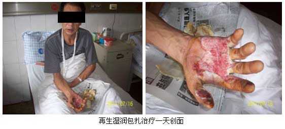 9170金沙集团_皖北煤电总医院再生回复手艺临床实践系列报道（二）