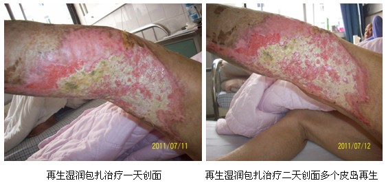9170金沙集团_皖北煤电总医院再生回复手艺临床实践系列报道（二）