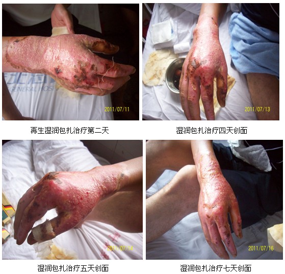 9170金沙集团_皖北煤电总医院再生回复手艺临床实践系列报道（二）